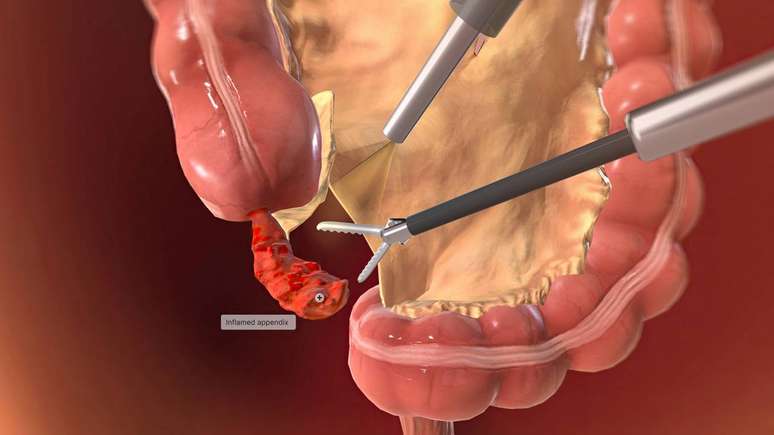 குடல் அழற்சி அறுவை சிகிச்சை_depositphotos.com/scienceanm
