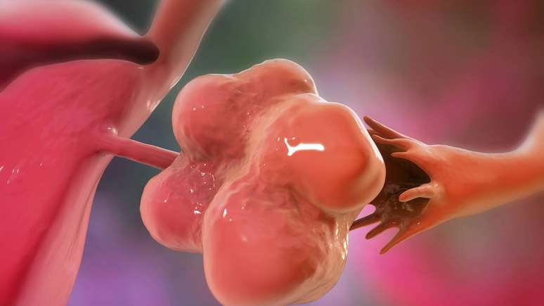 A s&iacute;ndrome do ov&aacute;rio polic&iacute;stico &eacute; definida por um conjunto de altera&ccedil;&otilde;es que envolvem ov&aacute;rios aumentados, presen&ccedil;a de m&uacute;ltiplos fol&iacute;culos (os chamados &ldquo;cistos&rdquo; no ultrassom), irregularidade menstrual e sinais de excesso de horm&ocirc;nios androg&ecirc;nicos &ndash; depositphotos.com / katerynakon