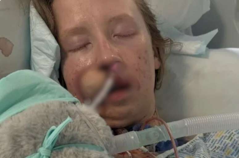 Jovem precisou passar por v&aacute;rios cirurgias de reconstru&ccedil;&atilde;o da face