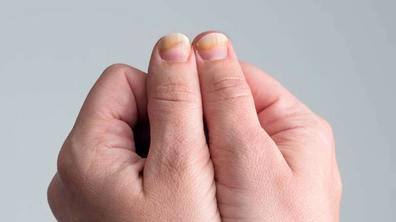 Unhas quebradi&ccedil;as &ndash; depositphotos.com / LyaNevada