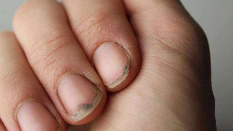 Unhas quebradi&ccedil;as &ndash; depositphotos.com / LyaNevada