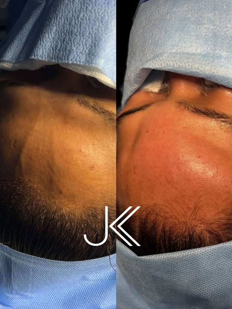 Antes e depois da testa de Camila Loures