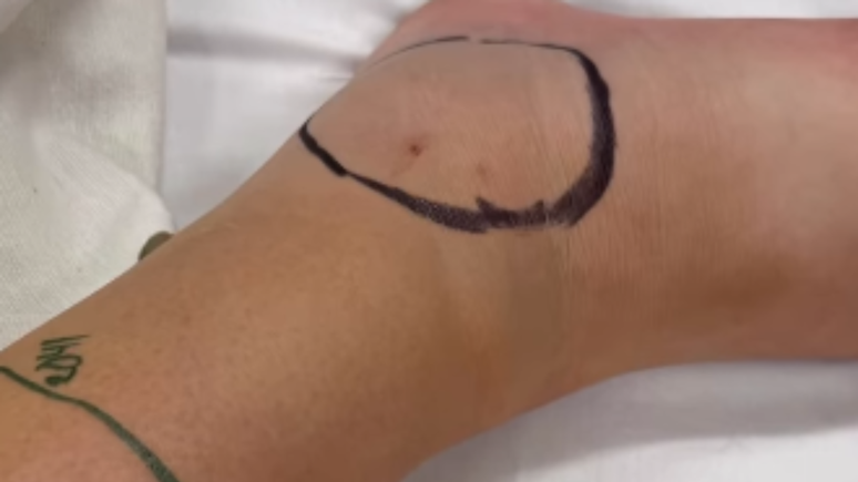 Adolescente fica em estado grave ap&oacute;s ser picada por cascavel durante passeio de bicicleta