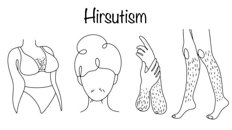 Com avalia&ccedil;&atilde;o m&eacute;dica e tratamento adequado, &eacute; poss&iacute;vel controlar o hirsutismo e reduzir seu impacto na autoestima e na qualidade de vida &ndash; depositphotos.com / anna_art.r