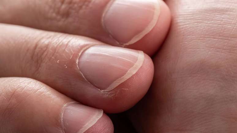 Unhas quebradi&ccedil;as &ndash; depositphotos.com / LyaNevada