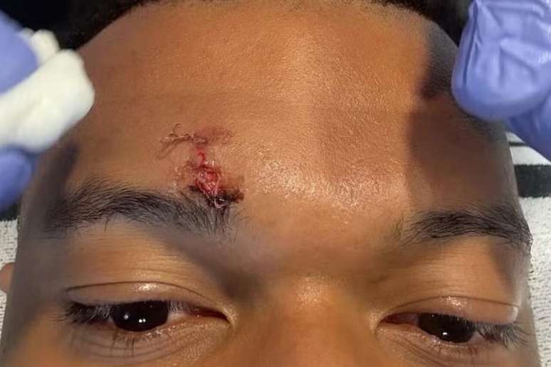 Mbapp&eacute; levou pontos no rosto ap&oacute;s cotovelada de Vitor Reis em Real Madrid x Girona &mdash;