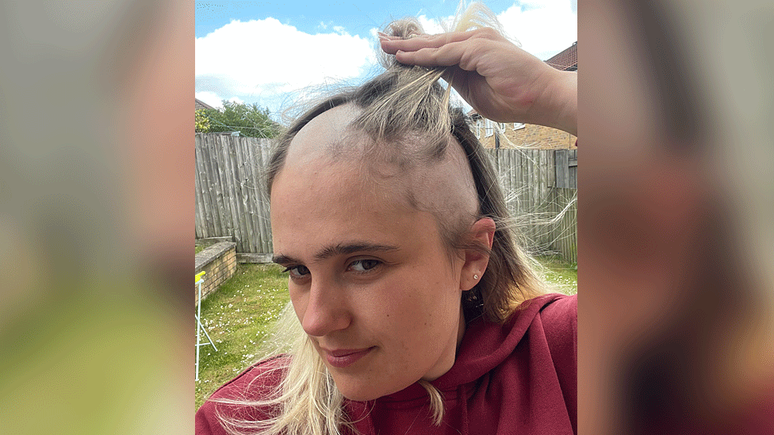 Em junho de 2025, Phoebe Tesoriere perdeu todo o seu cabelo