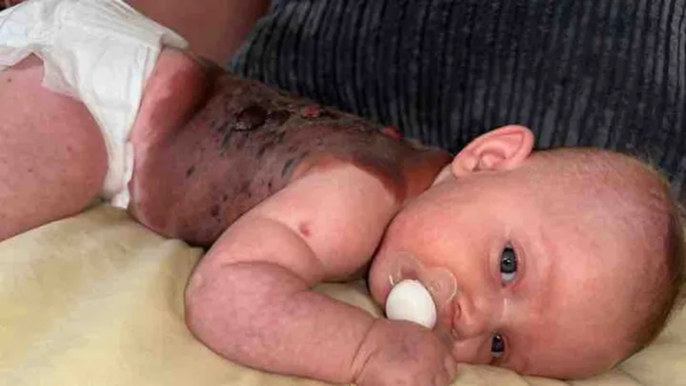 Macey-Mai &eacute; filha de Katelyn Clarke, de 23 anos, e nasceu com condi&ccedil;&atilde;o rara