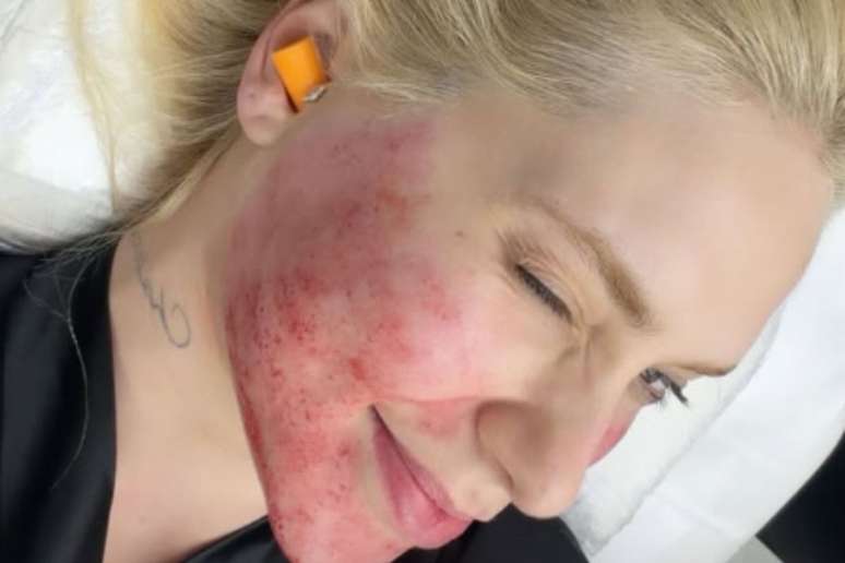 Virginia ap&oacute;s realizar o procedimento em 2026