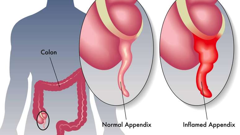 Um pequeno &ldquo;beco sem sa&iacute;da&rdquo; no intestino pode gerar uma grande inflama&ccedil;&atilde;o &ndash; depositphotos.com / rob3000