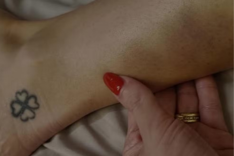 Larissa Ferrari mostra manchas em seu corpo &ndash;