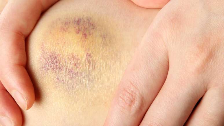 Hematoma &ndash; depositphotos.com / payphoto