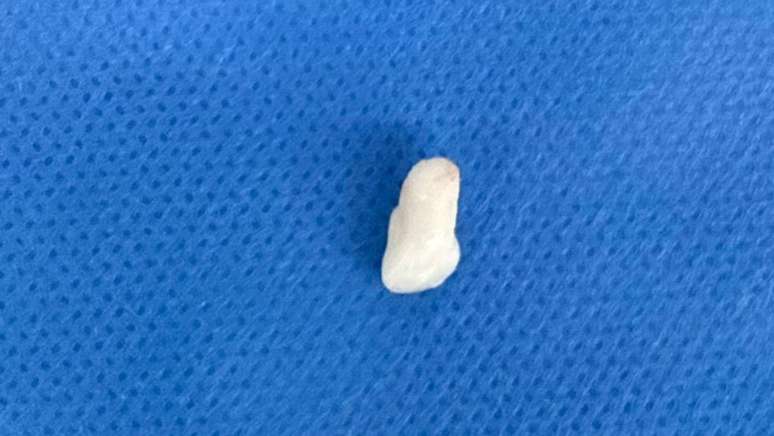 Dente removido cirurgicamente de dentro do nariz de crian&ccedil;a