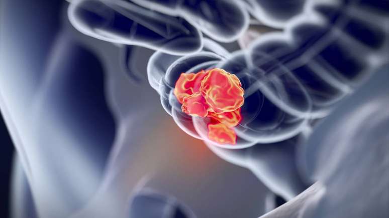 O uso do pembrolizumabe antes da cirurgia &eacute; chamado de tratamento neoadjuvante. A ideia &eacute; tratar o c&acirc;ncer colorretal enquanto o tumor ainda est&aacute; no organismo, com circula&ccedil;&atilde;o sangu&iacute;nea preservada, permitindo maior contato entre o sistema imunol&oacute;gico e o pr&oacute;prio tumor. Isso cria uma esp&eacute;cie de &ldquo;treinamento&rdquo; para as c&eacute;lulas de defesa &ndash; depositphotos.com / AnatomyInsider