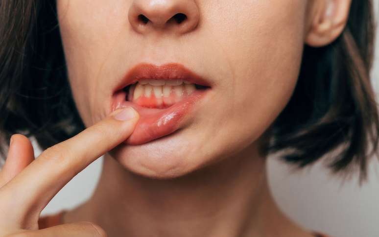 Dente mole em adultos /