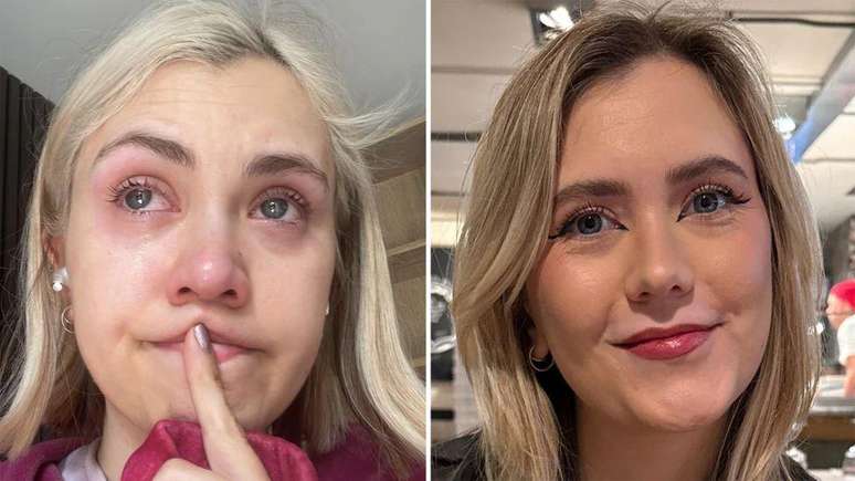 Lily Rose Winter, de 31 anos, levou anos para receber o diagn&oacute;stico de transtorno disf&oacute;rico pr&eacute;-menstrual