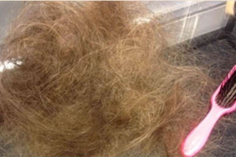 Apesar de usar uma touca t&eacute;rmica durante a quimioterapia, Victoria perdeu entre 50% e 75% do cabelo