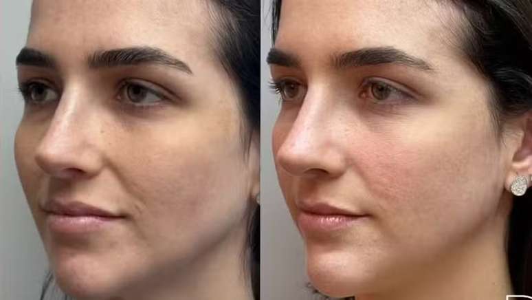 Duda Fournier, influenciadora e esposa de Paquet&aacute;, fez harmoniza&ccedil;&atilde;o facial