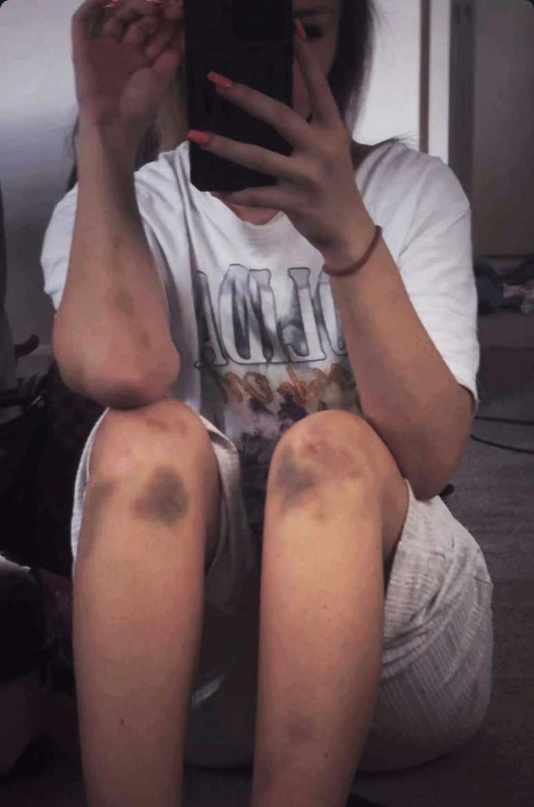 Rebecca mostrou &agrave; BBC fotografias dos hematomas em seu corpo