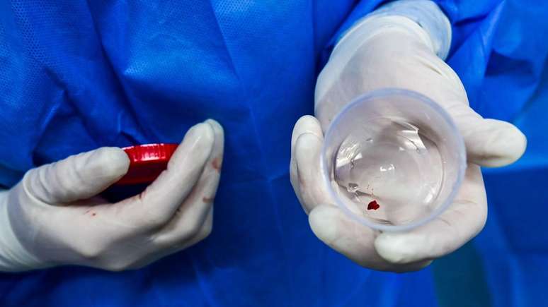 O tumor que afetou a sa&uacute;de de Gustavo &eacute; essa pequena mancha vermelha dentro do pote de pl&aacute;tico