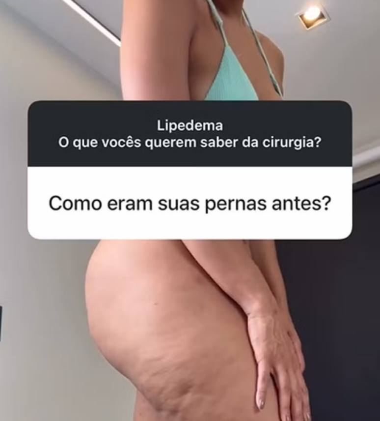 O lipedema, doen&ccedil;a cr&ocirc;nica que gera um ac&uacute;mulo desproporcional de gordura, deixou lembran&ccedil;as traum&aacute;ticas &agrave; atriz Barbara Reis
