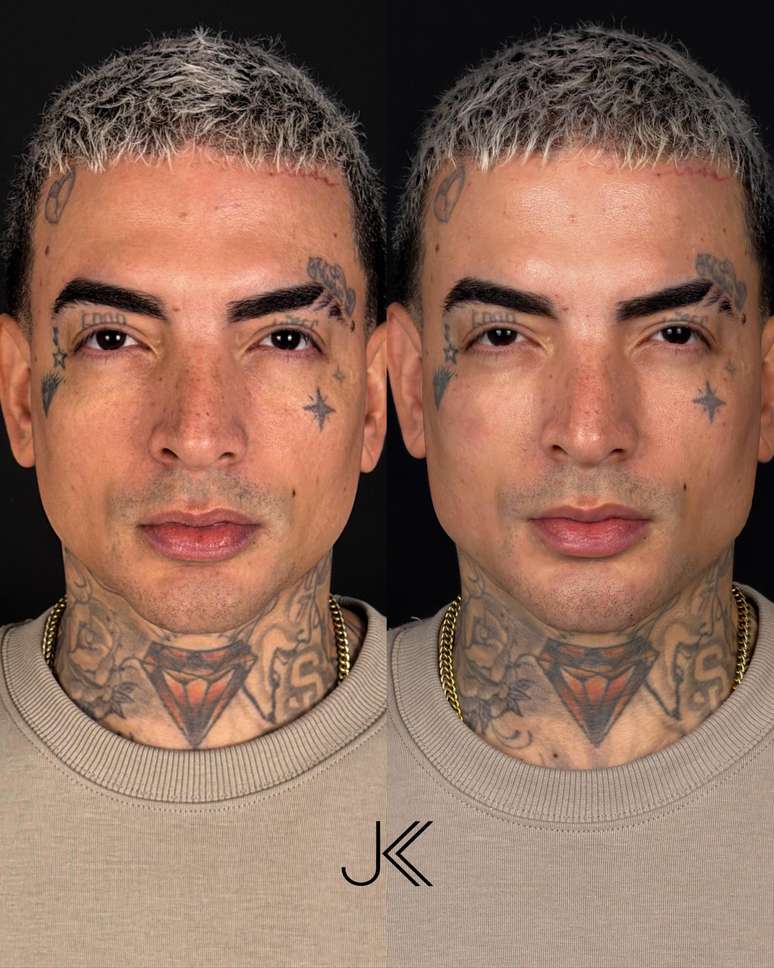 Antes e depois da manuten&ccedil;&atilde;o da harmoniza&ccedil;&atilde;o de MC Guim&ecirc;