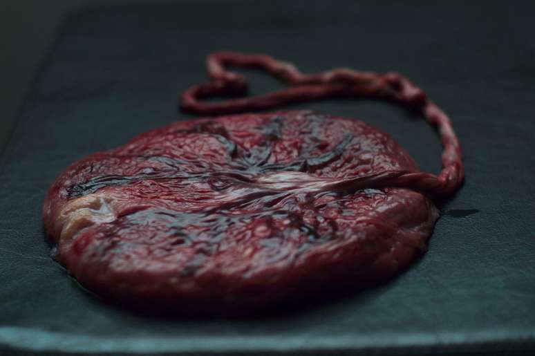 N&atilde;o h&aacute; evid&ecirc;ncias cient&iacute;ficas conclusivas sobre a efic&aacute;cia antienvelhecimento da placenta humana