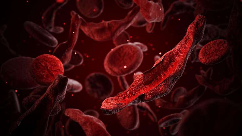 A tecnologia Crispr &eacute; aprovada em algumas partes do mundo para o tratamento de transtornos sangu&iacute;neos, como anemia falciforme, mas os seus custos ainda s&atilde;o muito altos
