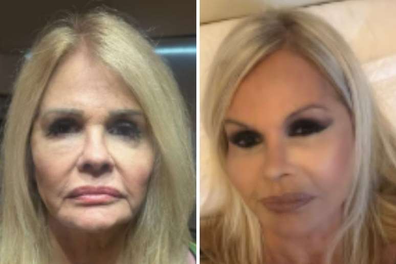 Monique Evans mostra antes e depois de procedimento 