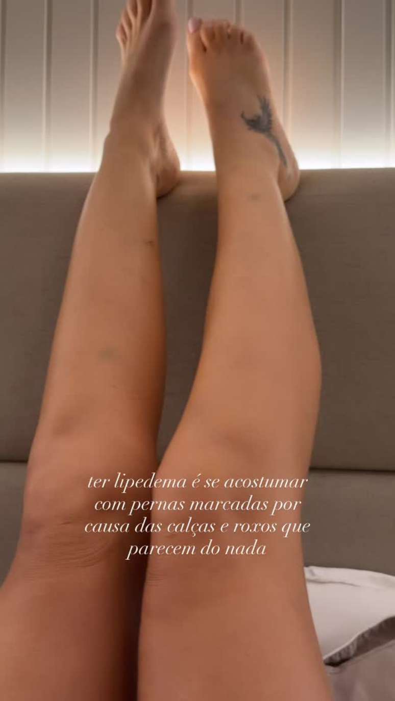 Yasmin Brunet mostra hematomas causados pelo lipedema