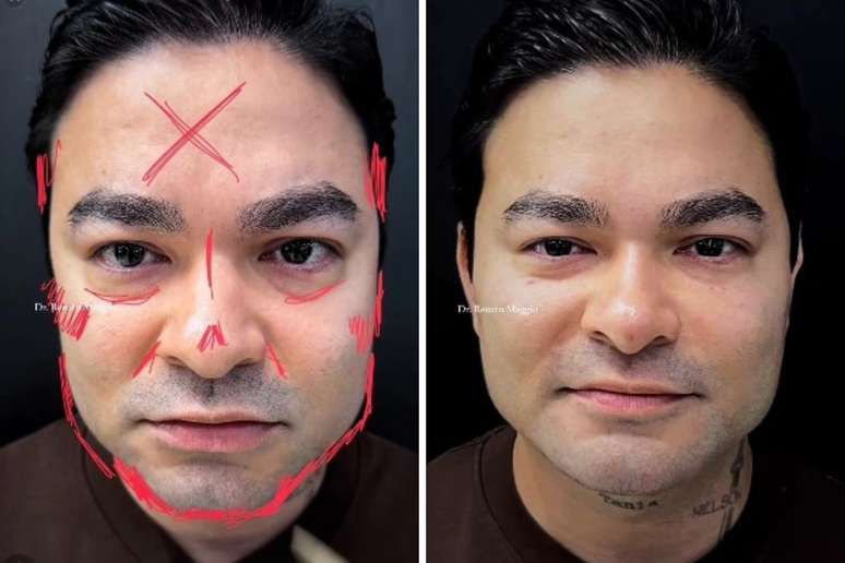 Profissional mostra onde retocou Yudi | Yudi ap&oacute;s procedimento de harmoniza&ccedil;&atilde;o