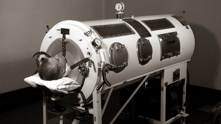 O pulm&atilde;o de a&ccedil;o era uma forma inicial de ventilador mec&acirc;nico. Ele era conectado a foles que faziam os pulm&otilde;es se expandirem e se contra&iacute;rem, permitindo que o paciente respirasse