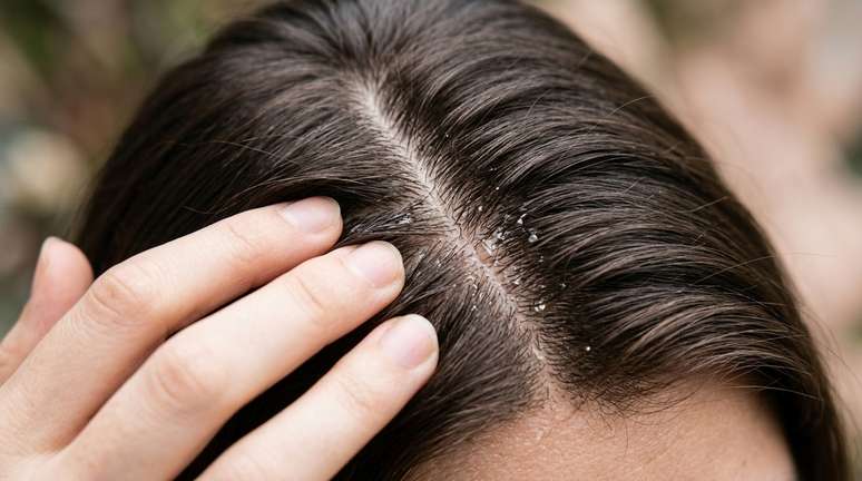 O ideal &eacute; dividir o cabelo em pequenas se&ccedil;&otilde;es e colocar o produto diretamente sobre o couro cabeludo, seguindo a quantidade e a frequ&ecirc;ncia indicadas pelo fabricante.