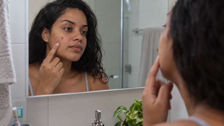 Espremer espinhas pode aumentar o risco de marcas persistentes.