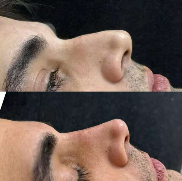 O resultado da harmoniza&ccedil;&atilde;o facial de Fiuk foi exibido ao vivo pelo SBT