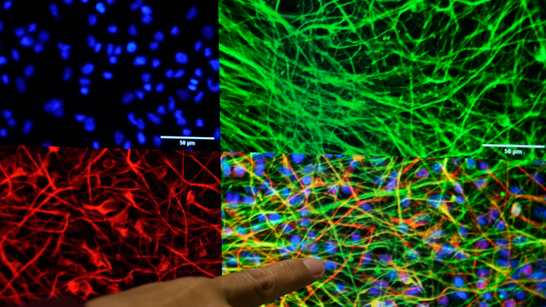 A esquizofrenia &eacute; um transtorno cerebral e os cientistas identificaram mais de 250 genes que podem estar relacionados ao seu desenvolvimento