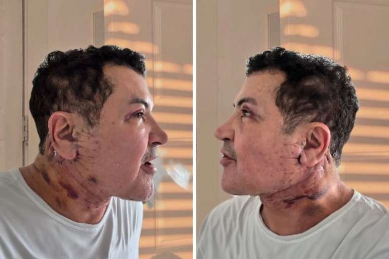 Cantor Bebo Barbosa mostra resultado de procedimento est&eacute;tico ap&oacute;s dois dias