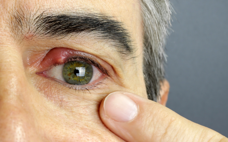 Ter&ccedil;ol &eacute; contagioso? / Cr&eacute;dito: Canva