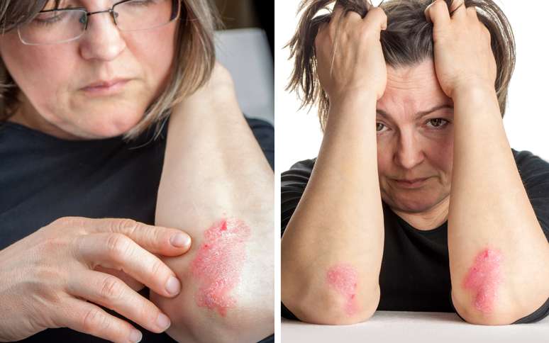 Psor&iacute;ase n&atilde;o &eacute; contagiosa