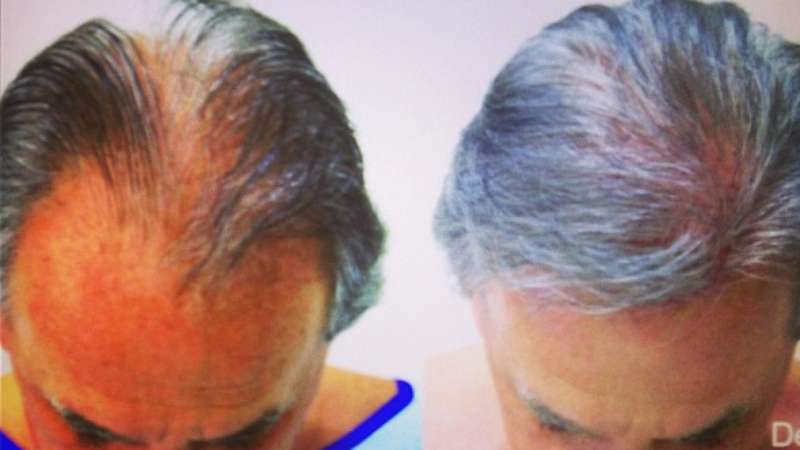 Otavio Mesquita Mostra Antes E Depois De Implante De Cabelo