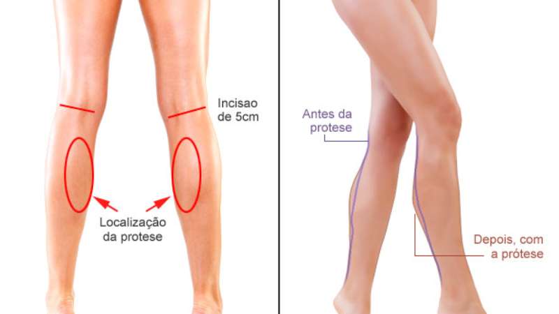 Eles são chamados de perneiras porque você coloca a perna sobre a cabeça