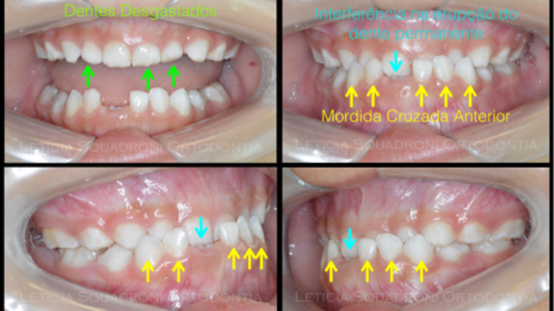 Dente Encavalado Na Frente - Oler Wallpaper