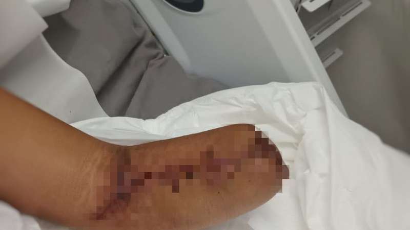 Imagem ilustrativa sobre Grávida perde bebê após amputação de perna em acidente de moto no Paraná; veja outros casos de amputação no país