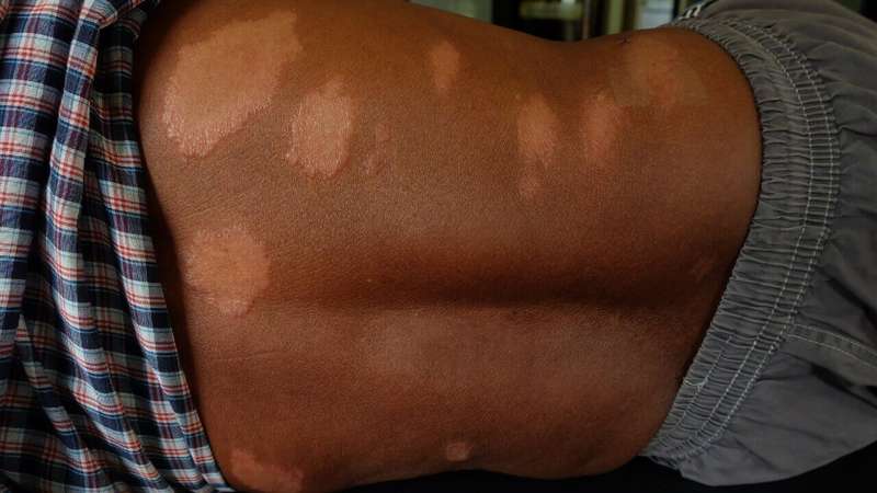 Brasil é o segundo país no mundo com mais casos de hanseníase;