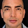 MC Guimê mostra antes e depois de harmonização facial