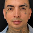 MC Guimê mostra antes e depois de harmonização facial; veja