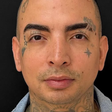 MC Guimê mostra antes e depois de harmonização facial; confira