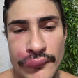 Influenciador Ken de CG é hospitalizado com infecção após espremer espinha