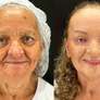 Antes e depois do tratamendo de Peeling de Fenol em Maria Ivone Foto: Divulgação/Lucas Miranda