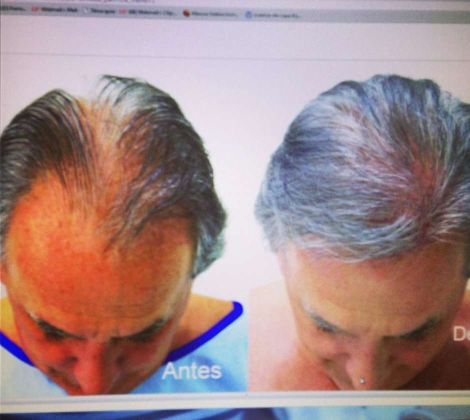 Otavio Mesquita Mostra Antes E Depois De Implante De Cabelo